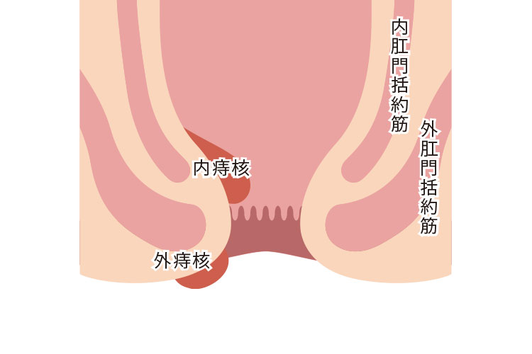 内痔核のイメージ