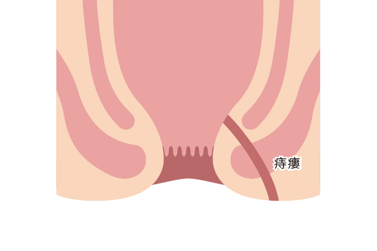 痔瘻のイメージ